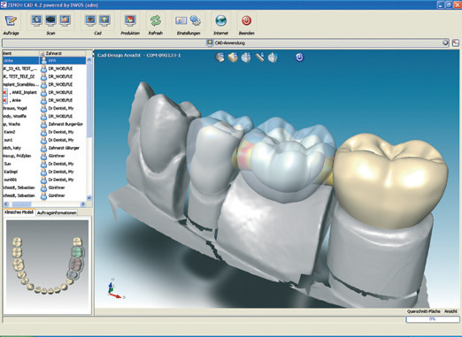 Цифровая стоматология - технология 3D моделирования зубов и десен