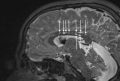 Мозг человека с болезнью Хантера © Igor Nestrasil, M.D., Ph.D., Carole Nguyen, University of Minnesota
