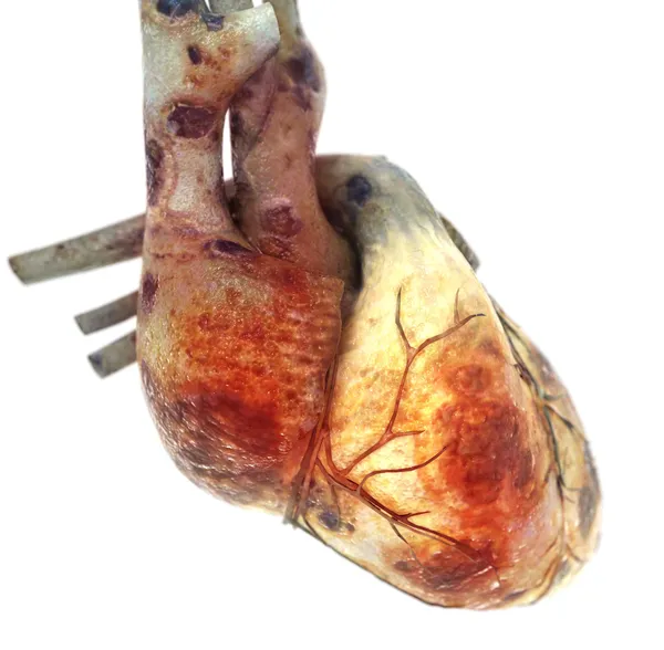 Анатомия больного сердца — стоковое фото